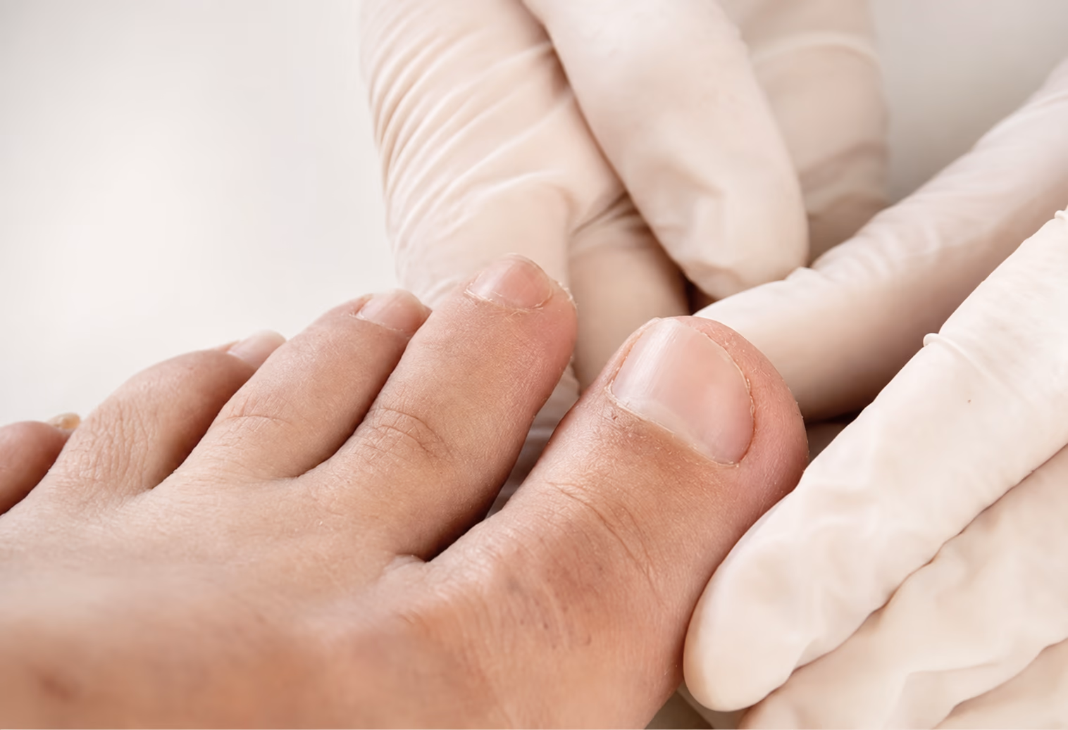 Después: uña del pie afectada por onicomicosis y su aspecto una vez renovada