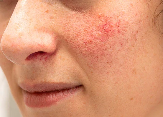 Rostro con enrojecimiento facial por rosácea