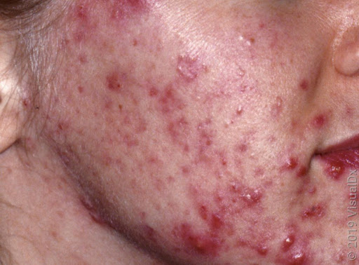 Piel con lesiones de acné inflamatorio
