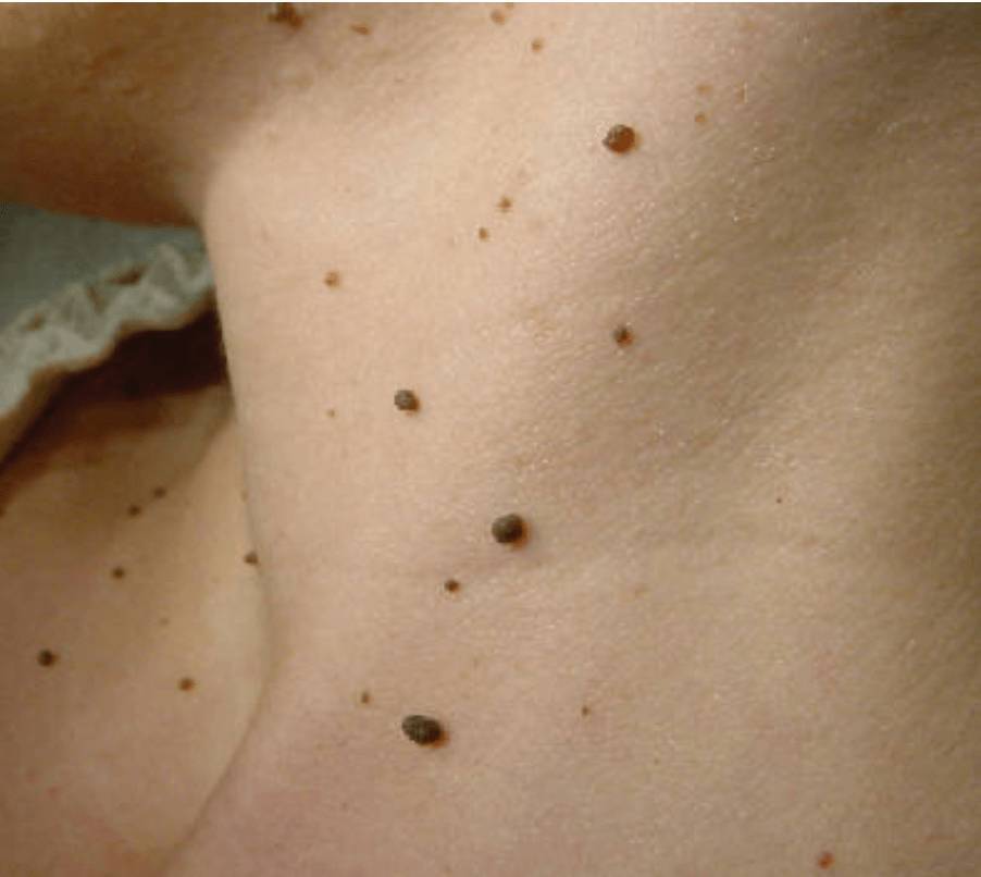 Acrocordones en la piel del cuello